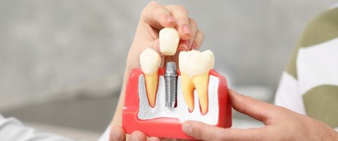 How Dental Implants Protect Your Oral Health?