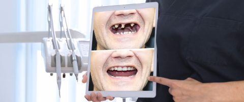 What to Anticipate During a Full Mouth Rehabilitation